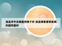 南昌市牛皮癣医院哪个好 南昌哪里看银屑病的医院最好