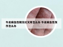 牛皮癣急性期又红又厚怎么办 牛皮癣急性发作怎么办
