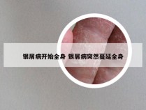 银屑病开始全身 银屑病突然蔓延全身