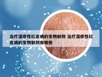 治疗湿疹性红皮病的生物制剂 治疗湿疹性红皮病的生物制剂有哪些