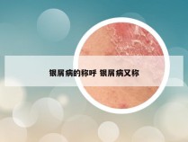银屑病的称呼 银屑病又称