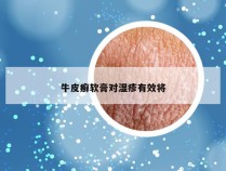 牛皮癣软膏对湿疹有效将