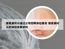 银屑病可以通过公司招聘体检要求 银屑病对入职体检有要求吗