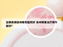 治银屑病徐州哪家医院好 徐州哪里治疗银牛屑好?