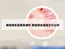 脚底硬皮是银屑病吗 脚底硬皮是缺少什么吗