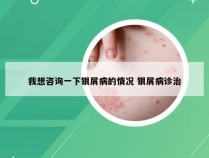 我想咨询一下银屑病的情况 银屑病诊治