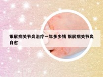 银屑病关节炎治疗一年多少钱 银屑病关节炎自愈