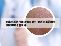 北京空军医院能治银屑病吗 北京空军总医院银屑病哪个医生好