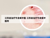 江苏省治疗牛皮癣中医 江苏省治疗牛皮癣中医院