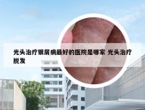 光头治疗银屑病最好的医院是哪家 光头治疗脱发