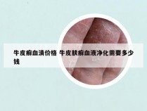 牛皮癣血清价格 牛皮肤癣血液净化需要多少钱
