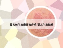 婴儿长牛皮癣好治疗吗 婴儿牛皮肤癣