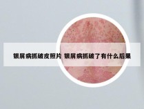 银屑病抓破皮照片 银屑病抓破了有什么后果