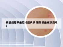 银屑病是不是结缔组织病 银屑病是皮肤病吗?