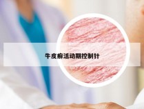 牛皮癣活动期控制针