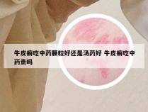 牛皮癣吃中药颗粒好还是汤药好 牛皮癣吃中药贵吗