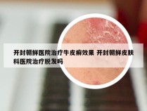 开封朝鲜医院治疗牛皮癣效果 开封朝鲜皮肤科医院治疗脱发吗
