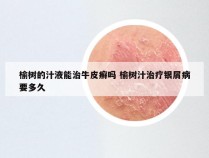 榆树的汁液能治牛皮癣吗 榆树汁治疗银屑病要多久