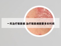 一天治疗银屑病 治疗银屑病需要多长时间