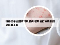 转移因子口服液对银屑病 银屑病打生物制剂到底好不好