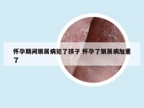 怀孕期间银屑病犯了孩子 怀孕了银屑病加重了