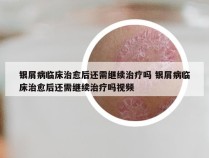 银屑病临床治愈后还需继续治疗吗 银屑病临床治愈后还需继续治疗吗视频