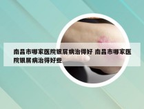 南昌市哪家医院银屑病治得好 南昌市哪家医院银屑病治得好些