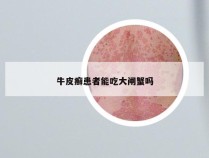 牛皮癣患者能吃大闸蟹吗