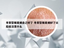 寻常型银屑病自己好了 寻常型银屑病好了以后应注意什么