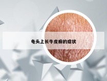 龟头上长牛皮癣的症状