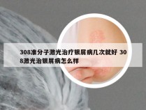 308准分子激光治疗银屑病几次就好 308激光治银屑病怎么样
