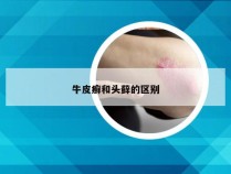 牛皮癣和头藓的区别