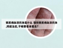 银屑病血清抗体是什么 强效银屑病血清抗体,彻底治愈,干嘛要看来看去?