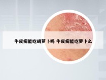 牛皮癣能吃胡萝卜吗 牛皮癣能吃萝卜么