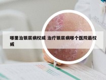 哪里治银屑病权威 治疗银屑病哪个医院最权威