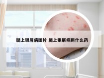 腿上银屑病图片 腿上银屑病用什么药