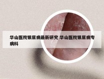 华山医院银屑病最新研究 华山医院银屑病专病科