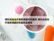 病灶放血治疗银屑病最好的医院 病灶放血治疗银屑病最好的医院是哪家