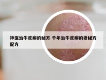 神医治牛皮癣的秘方 千年治牛皮癣的老秘方配方