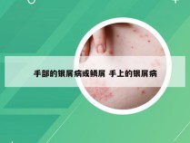 手部的银屑病或鳞屑 手上的银屑病