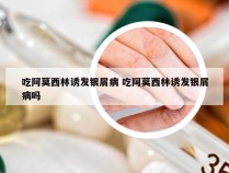 吃阿莫西林诱发银屑病 吃阿莫西林诱发银屑病吗