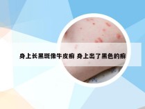 身上长黑斑像牛皮癣 身上出了黑色的癣