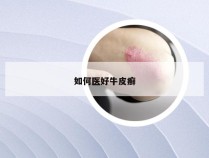 如何医好牛皮癣