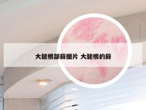 大腿根部藓图片 大腿根的藓