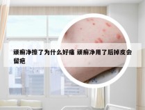 顽癣净擦了为什么好痛 顽癣净用了后掉皮会留疤