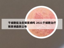 干细胞能治愈银屑病吗 2021干细胞治疗银屑病最新公布