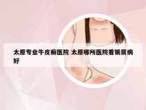 太原专业牛皮癣医院 太原哪所医院看银屑病好