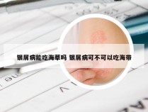 银屑病能吃海草吗 银屑病可不可以吃海带