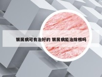 银屑病可有治好的 银屑病能治除根吗
