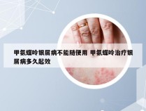 甲氨蝶呤银屑病不能随便用 甲氨蝶呤治疗银屑病多久起效